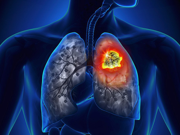 Nguyên nhân và dấu hiệu nhận biết của ung thư phổi