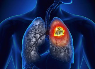 Nguyên nhân và dấu hiệu nhận biết của ung thư phổi