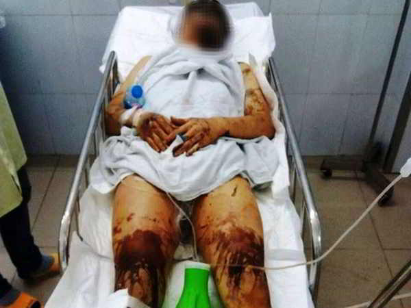 Anh trai nam Việt Kiều bị tạt axit cắt gân chân đã khóa số điện thoại sau khi về Canada