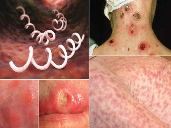 Giai đoạn 1: giai đoạn tiềm ẩn (giai đoạn loét săn)