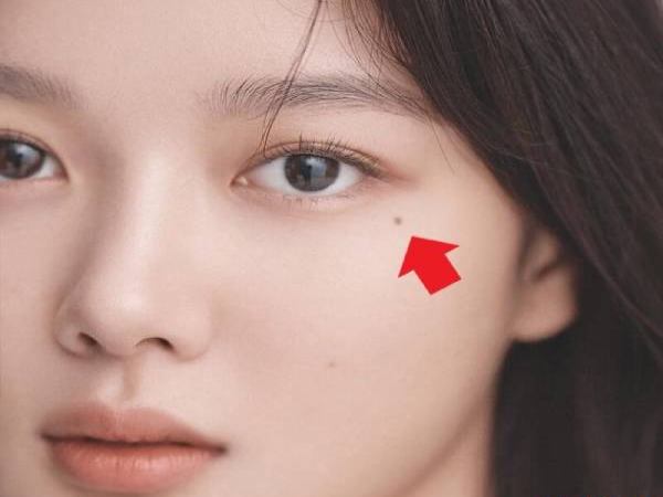 Nốt ruồi xuất ngoại là gì? Nốt ruồi xuất ngoại là gì?