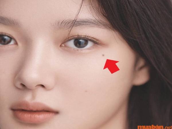 Nốt ruồi xuất ngoại là gì?
