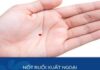 nốt ruồi xuất ngoại