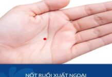 nốt ruồi xuất ngoại