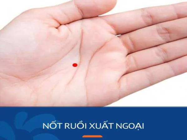 Nốt ruồi ở lòng bàn tay
